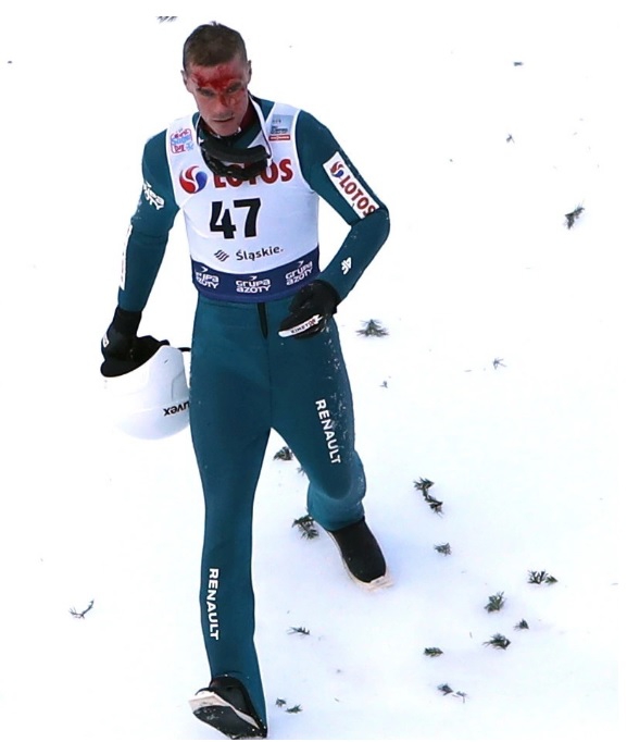 Upadek Piotra Żyły podczas konkursu w Wiśle. Polski skoczek stracił przytomność                                                                                           