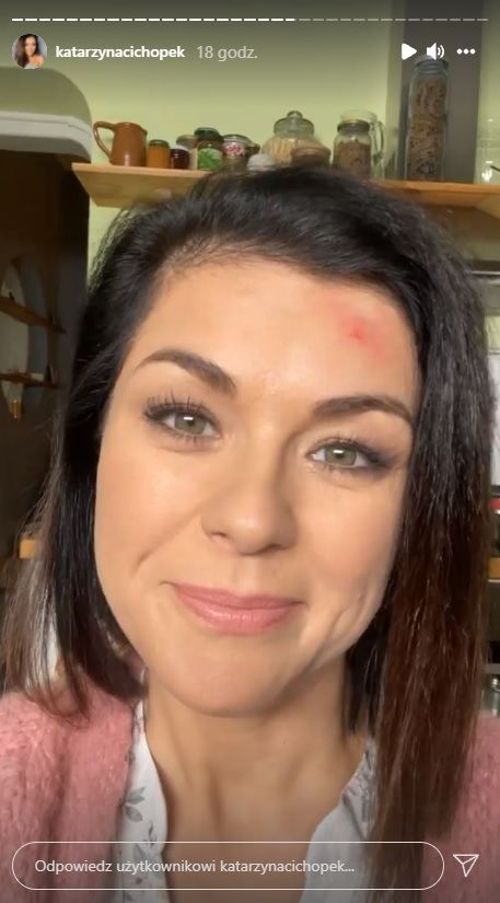 Gwiazda "M jak Miłość" pokazała "poturbowaną" twarz. Katarzyna Cichopek wyjaśnia, jak do tego doszło! 