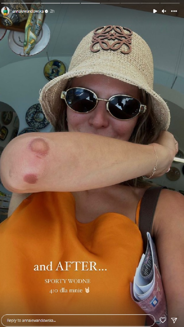 Anna Lewandowska doznała urazu. Pokazała zdjęcia! "Przed i po"