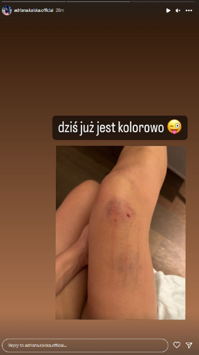 Adriana Kalska pokazała siniaki na nodze. Gwiazda "M jak miłość" wszystko wyjaśniła w opisie