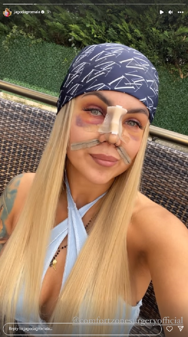 Uczestniczka "Love Island" tuż po operacji nosa. Jagoda zaprezentowała nos i opuchniętą twarz