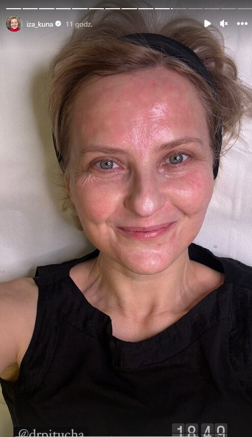 Iza Kuna nakłuwa sobie twarz! Tak wygląda po zabiegu [ZDJĘCIA]