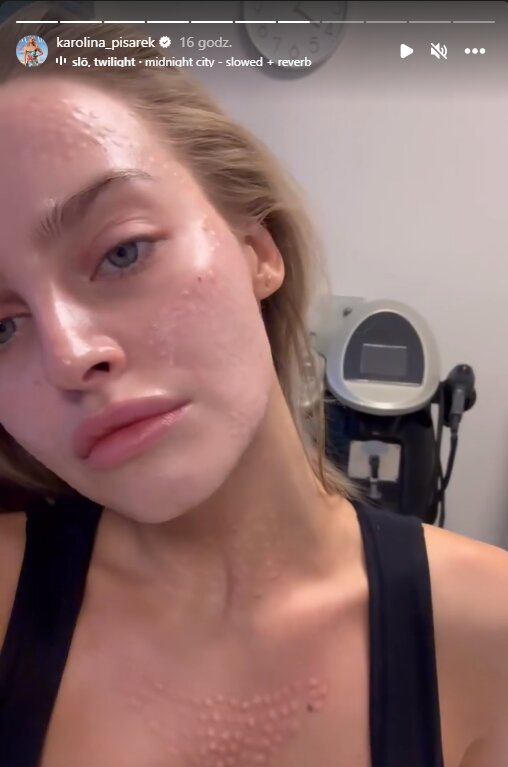 Karolina Pisarek zrobiła popularny zabieg kosmetyczny. Jak wyglądała tuż po?