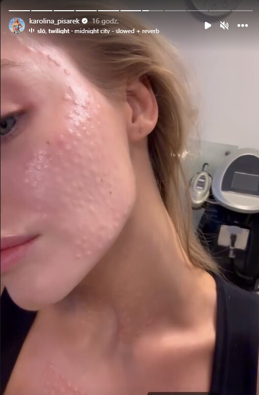 Karolina Pisarek zrobiła popularny zabieg kosmetyczny. Jak wyglądała tuż po?
